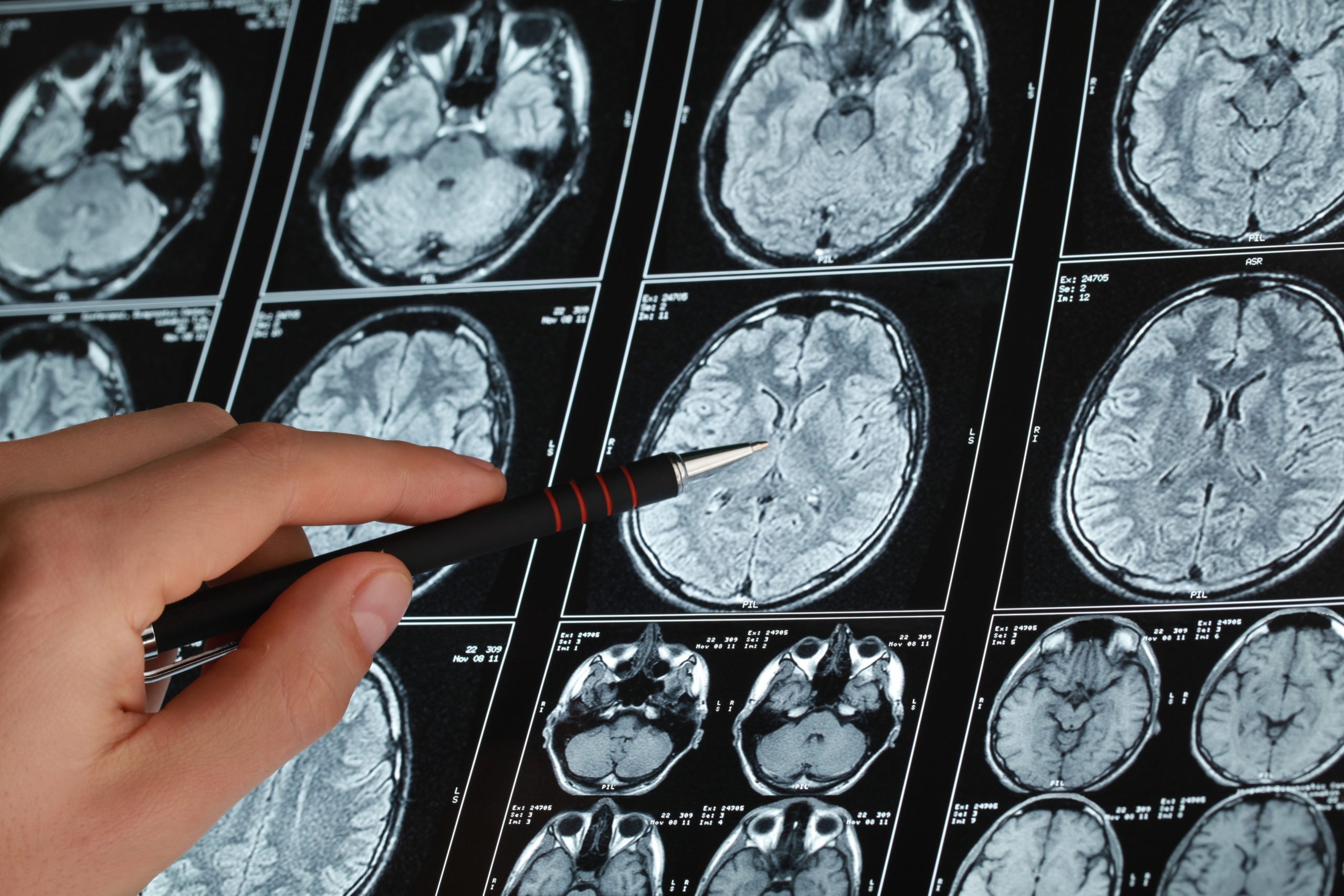 4 Most Frequent Causes of Brain Injuries